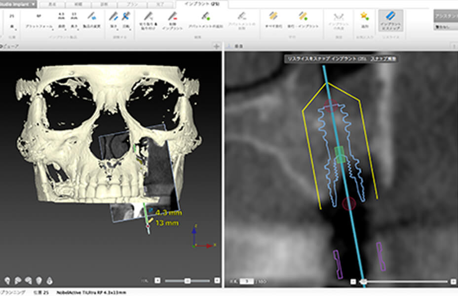 （図1）DTX Implant